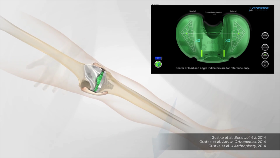 Chirurgie du genou - prothèse - Docteur Bardou-Jacquet - Bras robotisé Mako
