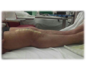 Récupération rapide après chirurgie du genou par le Dr BJ